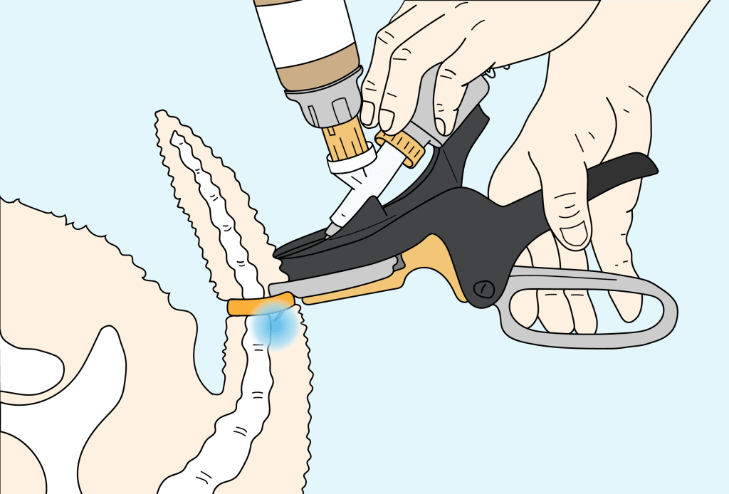 Numnuts® for taildocking diagram. Numnuts delivers local anaesthetic in combination with an Elastrator rubber ring